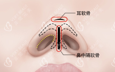韩国梦想整形外科隆鼻方法图