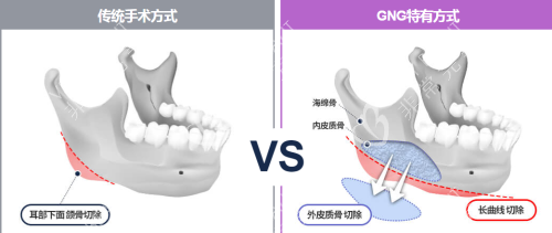 韓國(guó)gng整形醫(yī)院下頜角手術(shù)方法