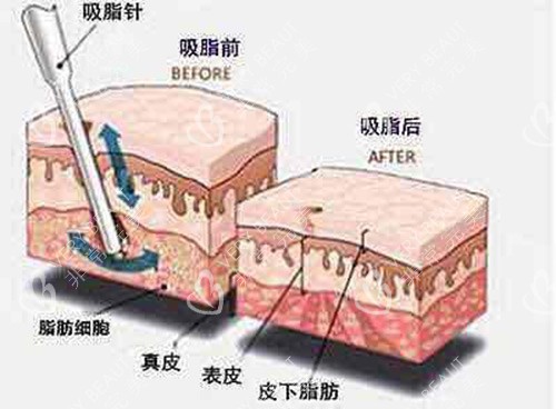 吸脂手術(shù)脂肪示意圖