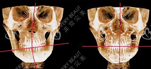 韩国菲斯莱茵整形双鄂手术CT对比