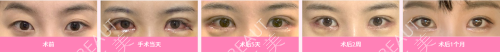 韓國綺林整形醫(yī)院開眼角手術對比