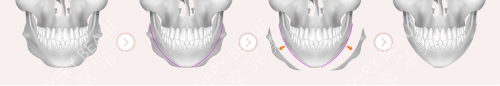 韩国VG百利酷整形下颌角手术