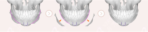 韩国VG百利酷整形下巴整形手术方法