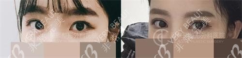 韓國可來熙整形醫(yī)院雙眼皮示意圖
