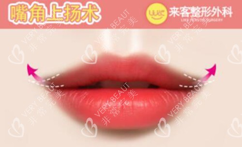 嘴角上揚(yáng)術(shù)改善治療