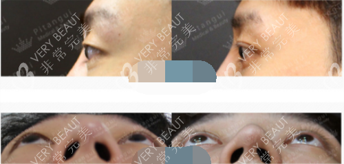 韓國(guó)必當(dāng)歸整形醫(yī)院突眼矯正實(shí)例