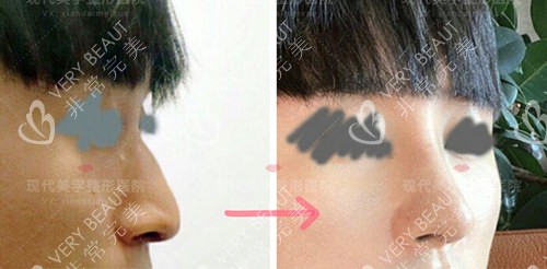 韓國現(xiàn)代美學(xué)整形外科男士鼻綜合實(shí)例圖