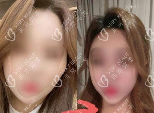 韓國現(xiàn)代美學(xué)整形外科顴骨手術(shù)實(shí)例圖