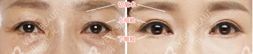 韓國(guó)珠兒麗整形醫(yī)院眼袋整形