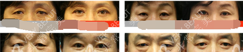 韓國(guó)珠兒麗整形醫(yī)院青春眼整形對(duì)比實(shí)例