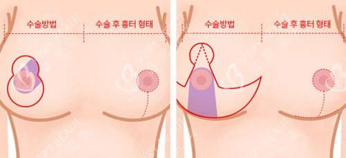 巨乳縮小手術(shù)示意圖