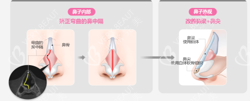 韓國(guó)gng整形醫(yī)院鼻部整形