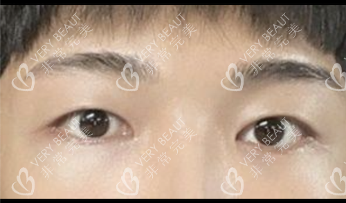 韓國來麗整形雙改單術(shù)后示意圖