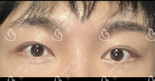 雙眼皮整形手術(shù)示意圖