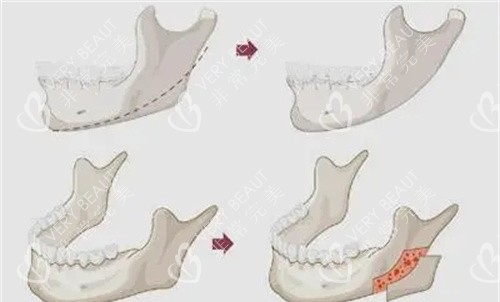 下颌骨去外板过程图