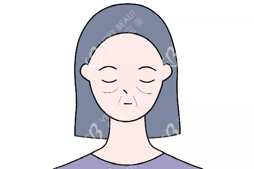 面部衰老卡通示意圖