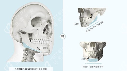 韩国NOTE整形外科轮廓整形特点