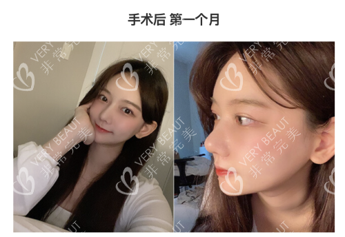 韓國(guó)GNG整形醫(yī)院手術(shù)后頭個(gè)月