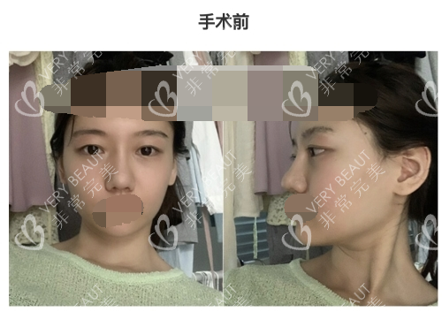 韓國(guó)GNG整形醫(yī)院手術(shù)前