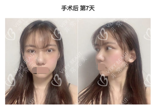韓國(guó)GNG整形醫(yī)院手術(shù)后第七天