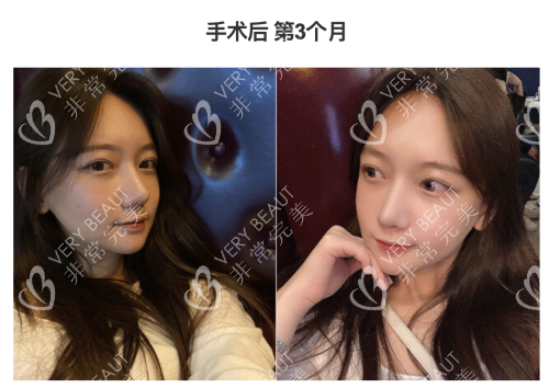 韓國(guó)GNG整形醫(yī)院手術(shù)后第三個(gè)月