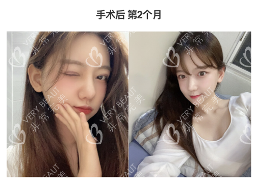 韓國(guó)GNG整形醫(yī)院手術(shù)后第二個(gè)月