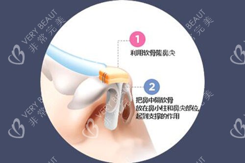 韓國(guó)GNG整形外科隆鼻特點(diǎn)分析