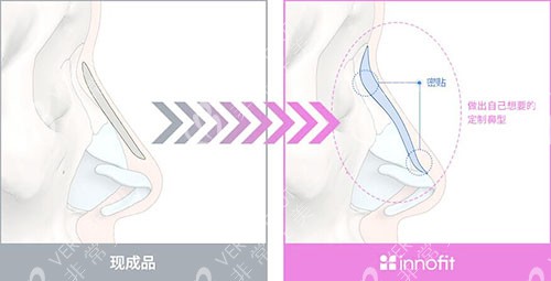 韓國(guó)GNG整形外科3D打印鼻介紹