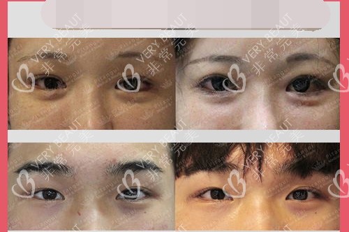 韓國必當(dāng)歸整形醫(yī)院凹眼矯正示意圖