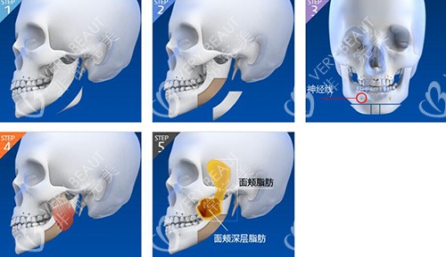 韓國必嫵做輪廓改善如何
