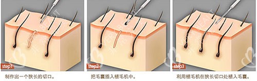 植發(fā)手術(shù)過程示意圖