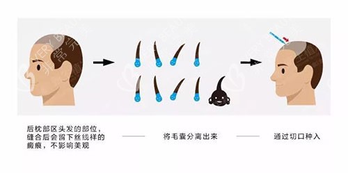 植發(fā)手術(shù)過程示意圖