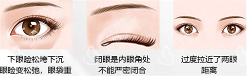 北京客莱美舍整形外科眼修复示意图