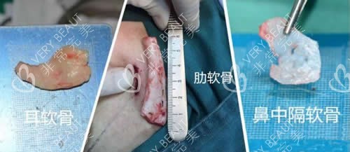 韩国nplus整形外科自体软骨隆鼻材料