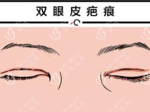 双眼皮疤痕修复示意图