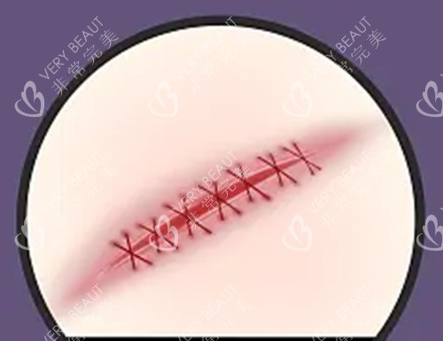 手術(shù)疤痕卡通示意圖