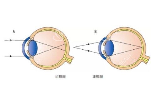 正常眼睛和近视眼卡通对比图