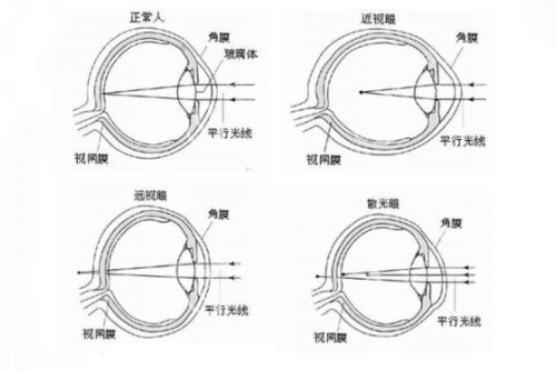 近视眼示例图