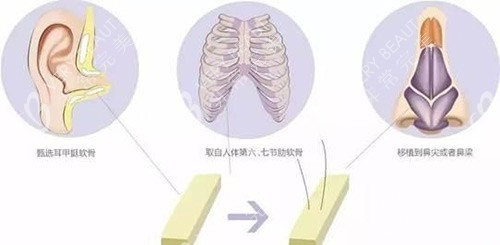 鼻部假体材料示意图