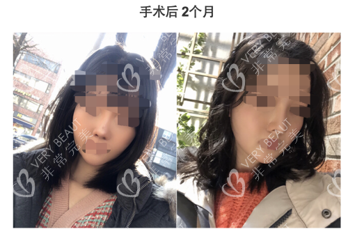 韓國GNG整形醫(yī)院輪廓2個月
