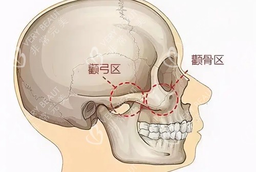 頭部顴弓顴骨位置示意圖