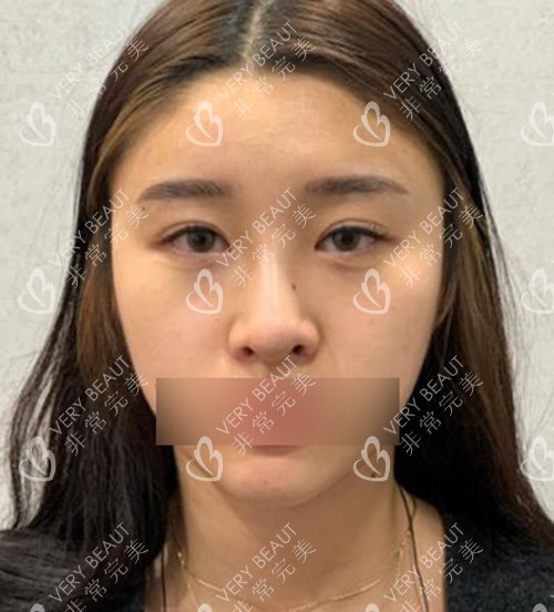 眼鼻修復(fù)前展示照片