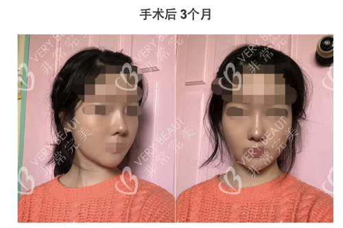 韓國GNG整形醫(yī)院輪廓3個月