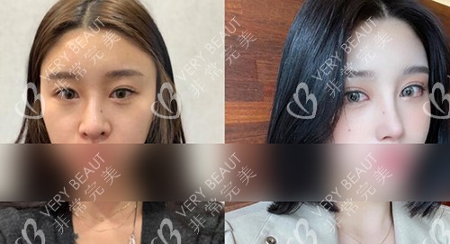 韓國AB整形眼鼻修復(fù)改善
