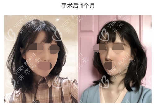 韓國GNG整形醫(yī)院輪廓手術(shù)后1個月