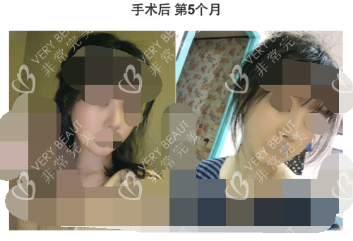 韓國GNG整形醫(yī)院輪廓術(shù)后5個月