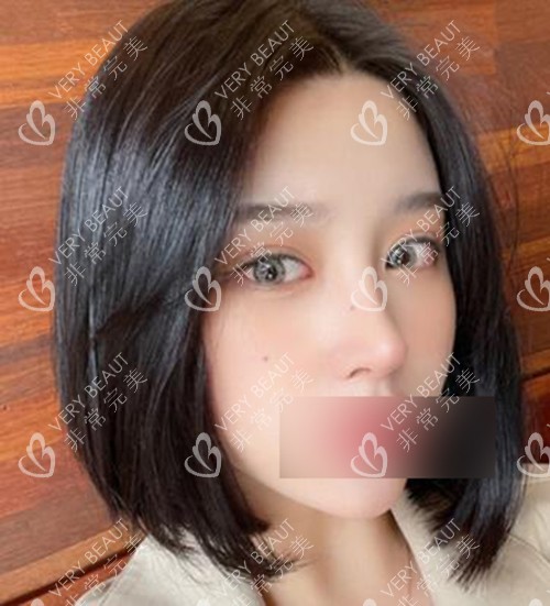 韓國AB整形做眼鼻修復(fù)改善