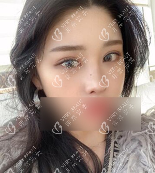 韓國AB整形眼鼻修復(fù)術(shù)后