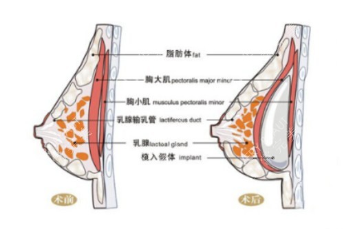 假体隆胸示例图