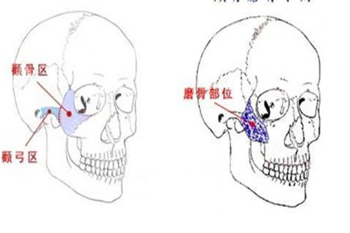 顴骨整形示意圖